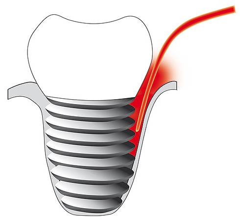 Bild Implantatentzündung / © Cumdente